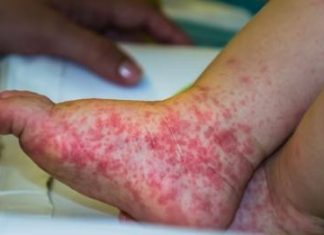 Creches de Araguaína registram 61 casos da síndrome mão-pé-boca em uma semana