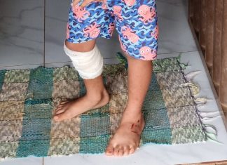 Menino mostra ferimentos pelo corpo após ser atropelado junto com irmãos na porta de casa; motorista foi preso por embriaguez