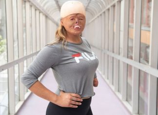 ‘Me olho no espelho, e gosto de mim’, diz atleta e modelo argentina que teve 88% do corpo queimado na infância