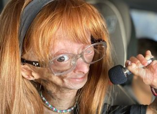 Morre aos 15 anos Adalia Rose, youtuber com ‘síndrome de Benjamin Button’ que tinha milhões de seguidores